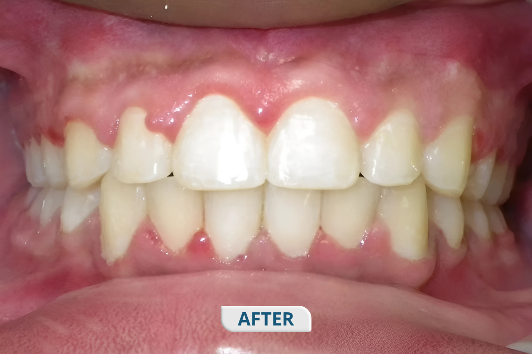 After treatment at Namira Oro Dental Care